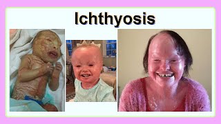 ichthyosis [upl. by Ariaet]