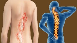 How Does Psoriatic Arthritis Affect The Spine [upl. by Ennayllek213]