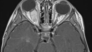 Optic Nerve Glioma [upl. by Atiekan]