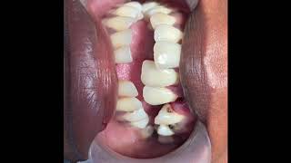 Upper jaw dental fracture treatment made quick n easy by Dr sunil richardson in south india [upl. by Rengia304]