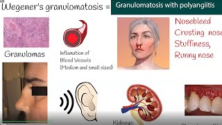 Wegeners granulomatosis  Granulomatosis with polyangiitis  Symptoms and causes [upl. by Troth]