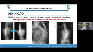 Escoliose idiopatica [upl. by Farr73]