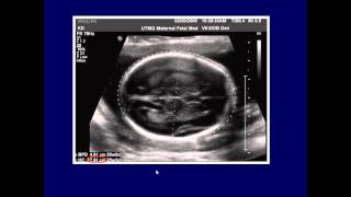 fetal biometry pptx [upl. by Lenka]