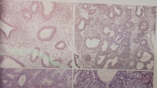 Endometritial Hyperplasia  SPECIAL PATHOLOGY [upl. by Thamora264]