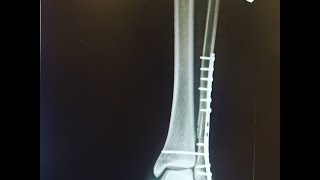 Recovery from fibula surgery [upl. by Libove]