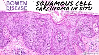 Squamous Cell Carcinoma In Situ Bowens Disease with Clear Cell Change 5Minute Pathology Pearls [upl. by Ade496]