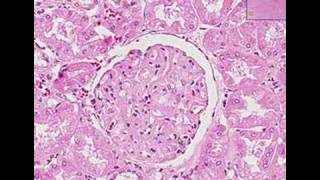 Histopathology Kidney Systemic lupus erythematosus [upl. by Willie]