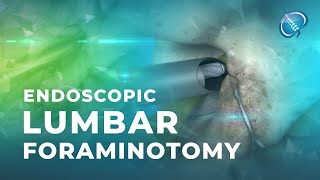 What is Endoscopic Lumbar Foraminotomy [upl. by Aimil]