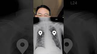 X光片判讀cystic lung ds [upl. by Olnek]