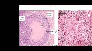 INFLAMMATION Part 8 GRANULOMA and granulomatous Inflammation [upl. by Adgam]