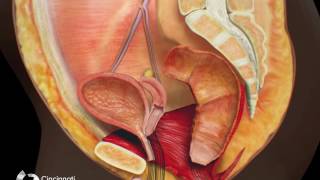 Surgical Treatment for Cloaca – Laparoscopic Approach  Cincinnati Childrens [upl. by Matazzoni]