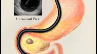 Endoscopic Ultrasound with Fine Needle Aspiration Biopsy [upl. by Liba643]