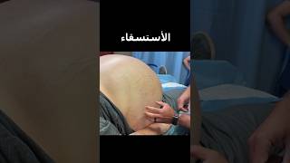 شاهد كيف يتم سحب السوائل من البطن الأستسقاء  Remove abdominal fluid ascites  Paracentesis [upl. by Grier]