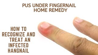 Pus under fingernail home remedy  How to Recognize and Treat an Infected Hangnail [upl. by Yorztif]