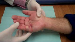 Xiaflex Injection  Manipulation for Dupuytrens Contracture [upl. by Teresa]