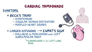 Clinical Reasoning Pericardial disease [upl. by Coy84]