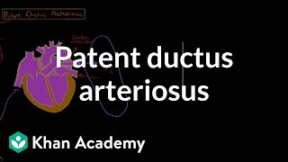 Patent ductus arteriosus  Circulatory System and Disease  NCLEXRN  Khan Academy [upl. by Ailemaj]