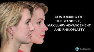 Contouring of the mandible rhinoplasty CASE 2 [upl. by Bock612]