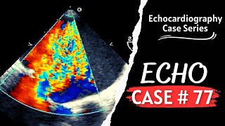 ECHO CASE 77  Echocardiography Spot Diagnosis Series  Echocardiogram Interpretation [upl. by Daveta]