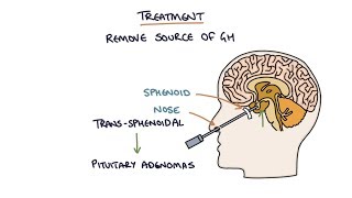 What is Homonymous Hemianopia [upl. by Riva]