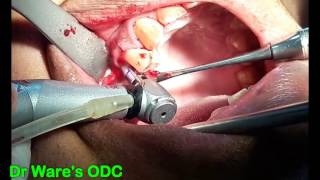 Implant placement in maxillary premolar region [upl. by Enal]