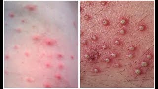 Home Remedies for Folliculitis  How to Get Rid of Folliculitis At Home [upl. by Nylarak]