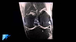 How to Read Knee MRI of Normal Knee  Anatomy of the Knee  Complex Knee Surgeon  Minneapolis  MN [upl. by Nahor]