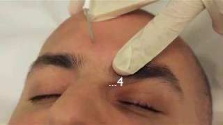 Sebaceous Hyperplasia Treatment using Electrodessication [upl. by Elsbeth]