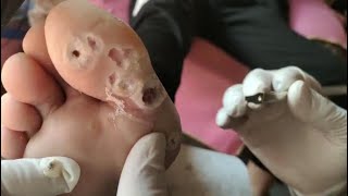 Wart 1 Plantar Wart Removal wart treatment This is for patient of trypophobia [upl. by Siari]