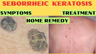 Understanding Seborrheic Keratosis Causes Symptoms Treatment Home Remedies [upl. by Eeima]