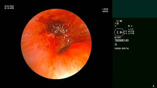 Airway Foreign Body  Whistle  Bronchoscopic retrievel [upl. by Neltiak]