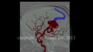 AVM  arteriovenous malformations in the brain amp cerebral hemorrhage animation by Cal Shipley MD [upl. by Launcelot499]