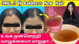 OMG😱 Baldness Hair Growth Treatment  frontal baldness hair regrowth in tamil  Jegathees meena [upl. by Paik614]