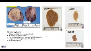 Nerve  Schwannoma Gross pathology [upl. by Tnomel]