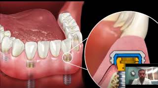 Dental Implant Overdenture  SnapIn Dentures [upl. by Pease]