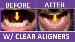 Aligners Journey  Invisible Braces Before And After [upl. by Seyer]