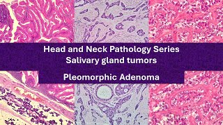 Pleomorphic Adenoma 101  highyield educational video [upl. by Lienad701]