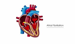 What is atrial fibrillation [upl. by Aicaca]