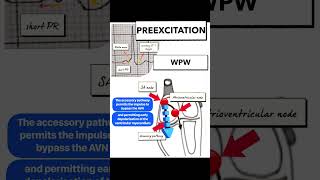 Overview of WolffParkinsonWhite WPW Syndrome [upl. by Orit]