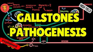 Pathogenesis of GALLSTONES formation Etiology of Cholesterol and Bilirubin gallstones [upl. by Marela]