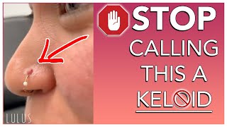 STOP CALLING BUMPS ON YOUR PIERCING KELOIDS [upl. by Mok]