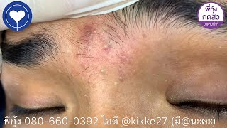 Big Cystic Acne Blackheads Extraction Blackheads amp Milia Whiteheads Removal Pimple Popping  5582 [upl. by Sargent806]