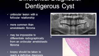 Ameloblastic Fibroma [upl. by Shargel]