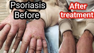 psoriasispsoriasis patient after treatment [upl. by Marlo783]