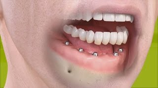 Straumann  Fixed restoration with 46 implants all straight [upl. by Adolphe414]