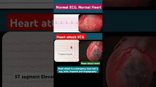 first test for heart attack l हार्ट अटैक के लिए टेस्ट l ecg echo angiography shorts [upl. by Halian]