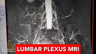 Lumbar Plexus MRI [upl. by Harmon491]