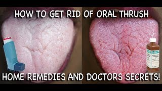 How to Treat Candida at Home Doctors Advice [upl. by Ettezus87]