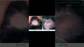 ALOPECIA AREATA TREATMENT RESULT hairloss shorts short viralpost [upl. by Araet529]