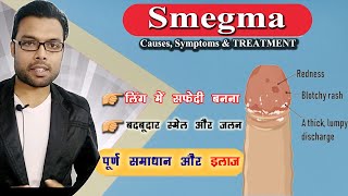 लिंग में सफेदी जमना और बदबूदार स्मेल का परमानेंट इलाज  Smegma  Smegma Treatment  Dr Nitish [upl. by Nalliuq537]